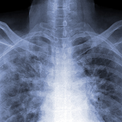 chest x-ray